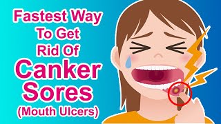 How To Cure Mouth Ulcer Canker Sores At Home Naturally  Home Remedies [upl. by Neerual]