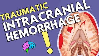 Intracranial Hemorrhage [upl. by Naleag963]