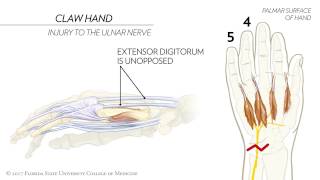 Claw Hand Ape Hand and the Sign of Benediction Animated Review [upl. by Etti]