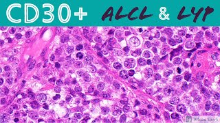 Anaplastic Large Cell Lymphoma amp Lymphomatoid Papulosis CD30 Positive Lymphoproliferative Disorders [upl. by Eevets283]