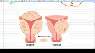 Adenomyosis  Concept  Diagnosis Management [upl. by Crichton]