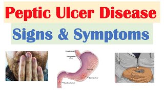 Peptic Ulcer Disease Gastric vs Duodenal Ulcers  Causes Symptoms Diagnosis Treatment [upl. by Sutherlan]