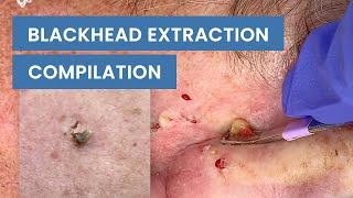 Extraction Satisfaction Blackhead Removal  CONTOUR DERMATOLOGY [upl. by Yumuk]