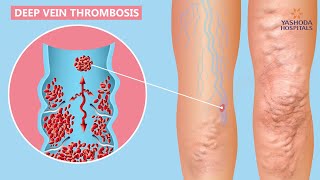 Understanding and Diagnosing Venous Thromboembolism VTE [upl. by Yarrum]