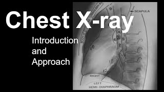 Chest Xray Introduction and Approach [upl. by Leinod828]