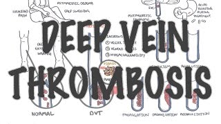 FAQs about Deep Venous Thrombosis DVT  Yashoda Hospitals [upl. by Magee]