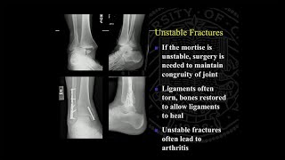 Ankle Replacement and Ankle Fusion Surgery and Recovery [upl. by Euqinomahs414]