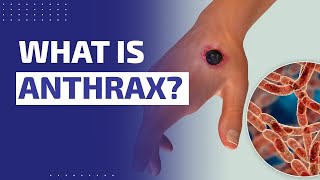 WHAT IS ANTHRAX [upl. by Anitserp770]