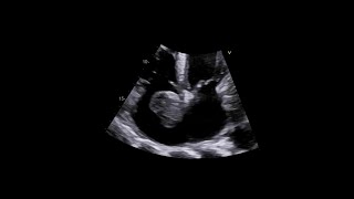 Primary Cardiac Synovial Sarcoma [upl. by Nosyk110]