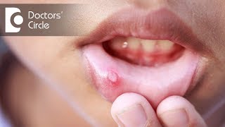 How can one treat Oral ulcers  Dr Arundati Krishnaraj [upl. by Namrac703]