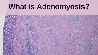 What is Adenomyosis  Pathology mini tutorial [upl. by Tina]