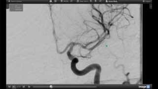 How Endovascular Stroke Treatment Works [upl. by Lennor]