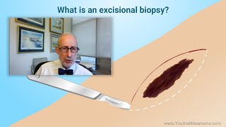 What kind of biopsies are used for melanoma [upl. by Eanar932]