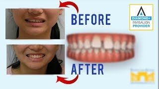 Invisalign Before and After Gap in Teeth [upl. by Jada792]