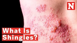 What Is Shingles [upl. by Coben]