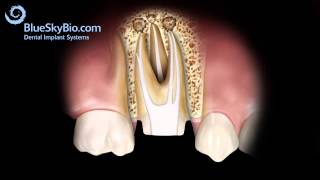 Patient Treatment Videos Root Canal Retreatment [upl. by Noirda]