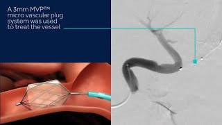 Discover Medtronics MVP™ micro vascular plug System and Concerto™ detachable coil system [upl. by Mame]