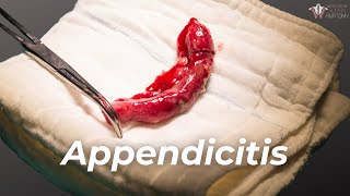 What Causes Appendicitis amp How to Treat It [upl. by Juliana]