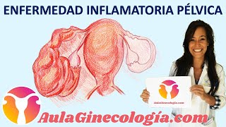 ENFERMEDAD INFLAMATORIA PÉLVICA EPI Síntomas y tratamiento  Ginecología y Obstetricia [upl. by Mellen862]