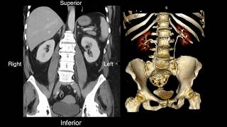 Normal Renal Anatomy [upl. by Blen]