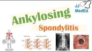 Ankylosing Spondylitis  HLAB27 Pathophysiology Signs amp Symptoms Diagnosis Treatment [upl. by Roselani]