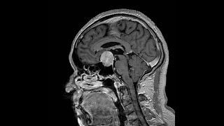 Tumores hipofisiarios Neurociencias [upl. by Shaia15]