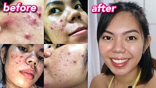 HOW I CLEARED MY ACNE  Cystic Hormonal Acne with PCOS Philippines [upl. by Erodeht]