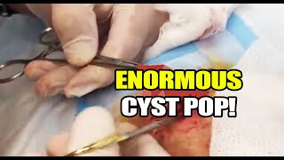 Enormous Cyst Removal Dr Gilmores Biggest Cysts [upl. by Nauqal952]