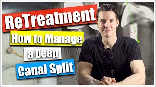 Root Canal Retreatment How Manage a Deep Canal Split Dr William Nudera Endodontist [upl. by Reisinger]