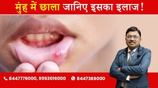 Mouth ulcers  Know why they happen  By Dr Bimal Chhajer  Saaol [upl. by Rufford]