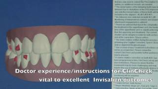 Invisalign ClinCheck Explanation [upl. by Uird]