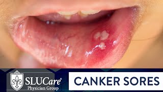 Determining Causes amp Treatment for Canker Sores  SLUCare Otolaryngology [upl. by Bradman807]