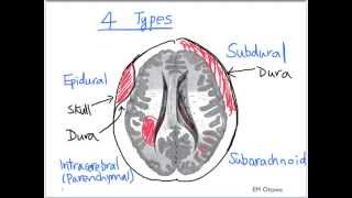 Intracranial Bleed  Part 1 [upl. by Anaerda]