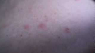 Shingles Rash Early Stages [upl. by Marilin]