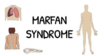 Marfan Syndrome Wrist and Thumb Sign [upl. by Swamy]