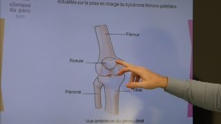 Cluster of Cook 13  Patellofemoral Pain Syndrome [upl. by Bili604]