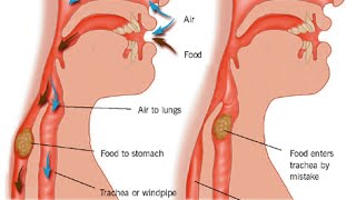 Aspiration Pneumonia [upl. by Yhtnomit771]