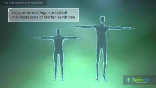 Marfan Syndrome About [upl. by Carolle]