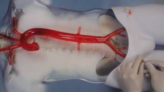 The ERREBOA™ Catheters Demonstration Video [upl. by Enomrej250]