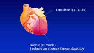 5 à 7 Dépister et prévenir linsuffisance cardiaque [upl. by Schram]