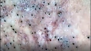 Blackheads removal from face  blackhead removal  acne 2019 [upl. by Ettellocin]