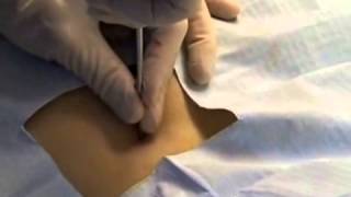 Biopsy Procedure Overview Dermatology [upl. by Hazrit]