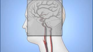 Neuro Embolization Procedure [upl. by Fornof]