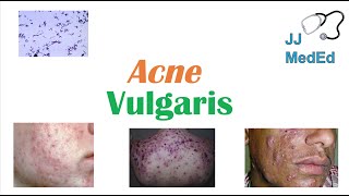 Acne Vulgaris  Causes Pathogenesis Influencing Factors Diagnosis Treatment and Complications [upl. by Nyleimaj]