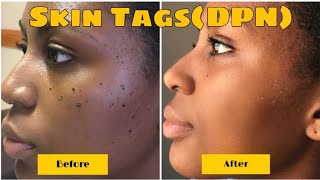 BEFORE AND AFTER DERMATOSIS PAPULOSA NIGRA REMOVAL RESULTS IN 1 WEEK  VIDEO  PHOTOS INCL [upl. by Allister]