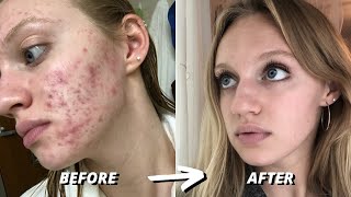 HOW I CLEARED 7 YEARS OF SEVERE ACNE  ACCUTANE JOURNEY [upl. by Had]