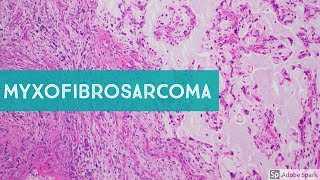 Myxofibrosarcoma 101Explained by a Sarcoma Pathologist [upl. by Callas]