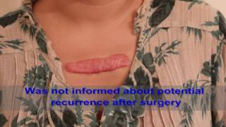 Chest Keloids  Mistakes to Avoid [upl. by Malley]