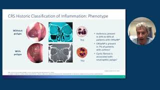 What is allergic rhinitis  Respiratory system diseases  NCLEXRN  Khan Academy [upl. by Eyoj]