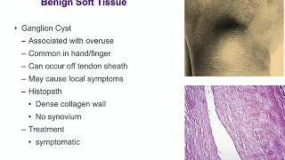 Malignant Soft Tissue Tumors  ABOS Orthopedic Surgery Board Exam Review [upl. by Florin]